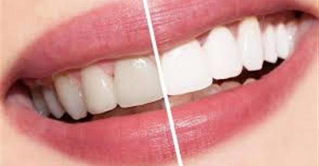 وصفة طبيعية لـ تبييض الاسنان